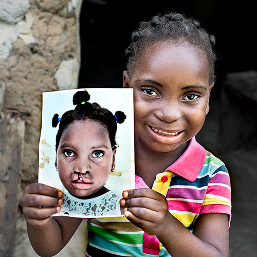 
Operation Smile-Before and After